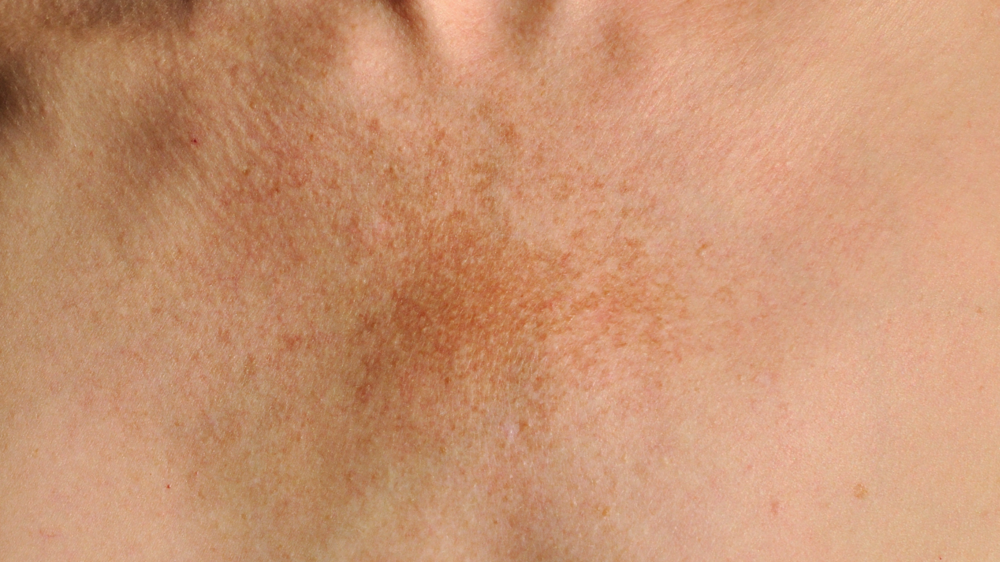 Ivanhoe Skin Clinic | Is Rejuran PN the Breakthrough Solution for ...